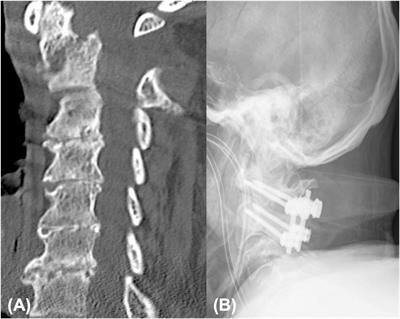 Morbidity and mortality related to type II odontoid fractures in octogenarians undergoing surgery: a retrospective study with 5 year follow up